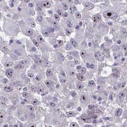 Immunohistochemistry: NFXL1 Antibody [NBP2-31746] - melanoma