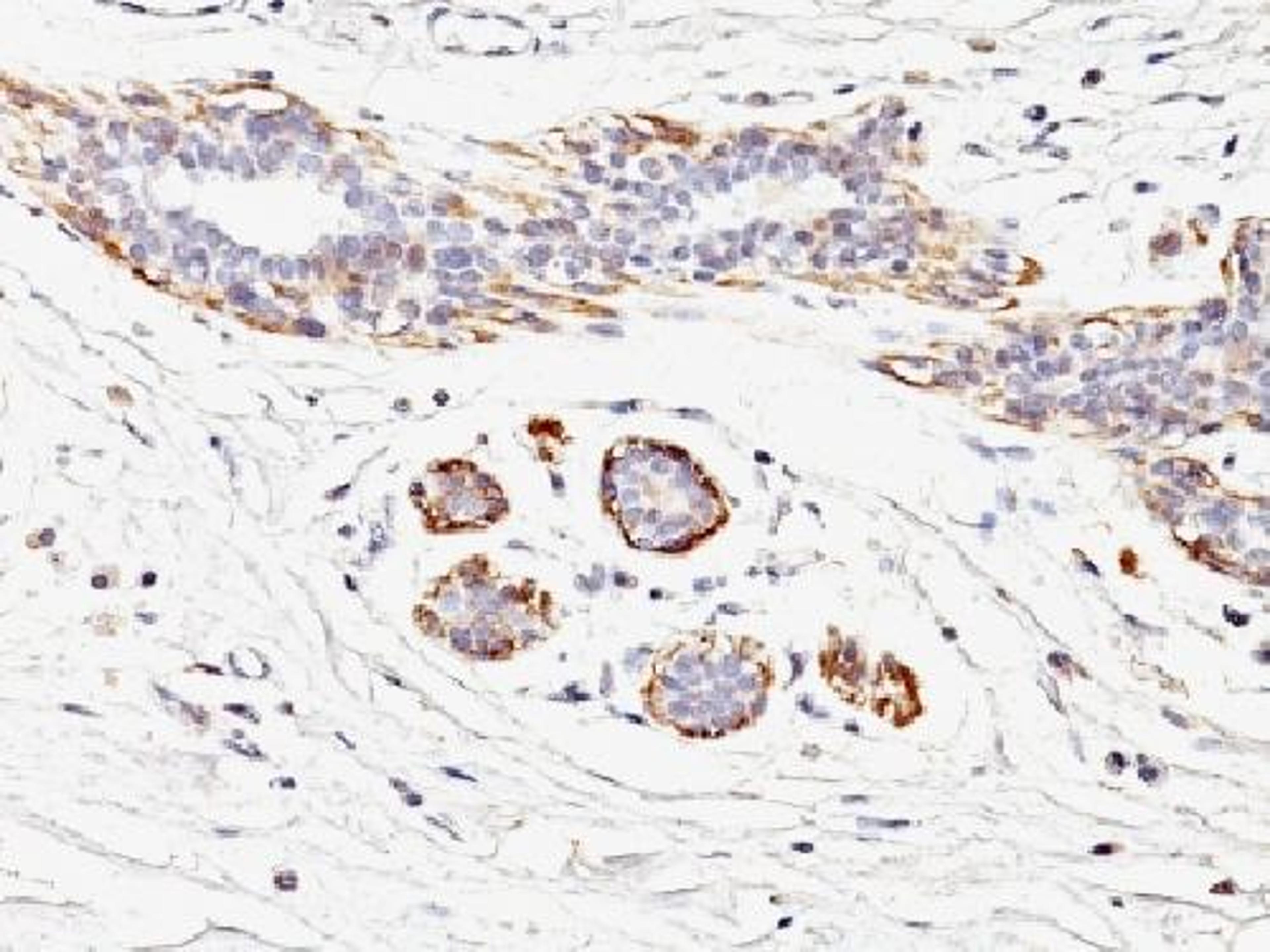 Immunohistochemical staining of human Breast Carcinoma tissue using MYH11 antibody