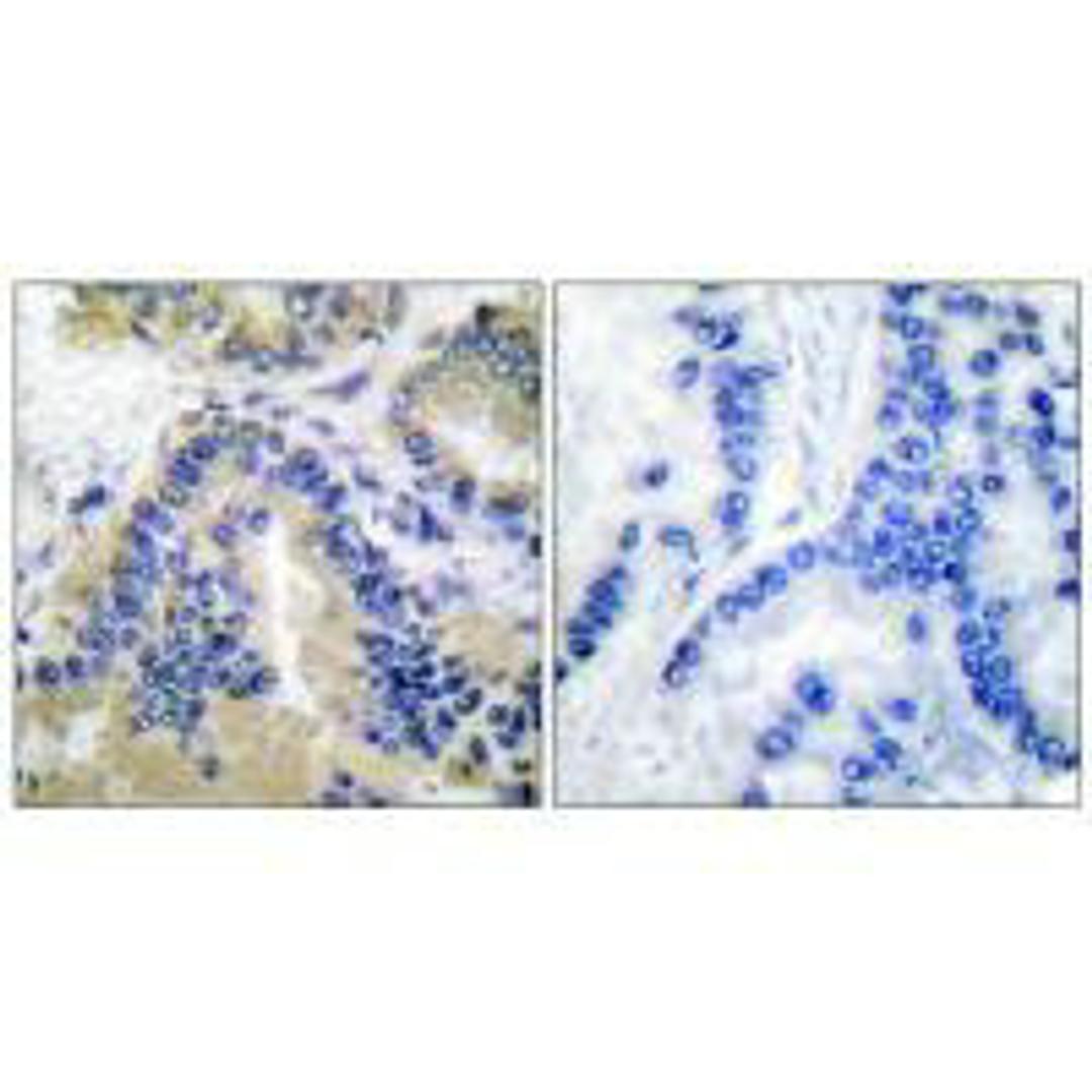 Immunohistochemical analysis of paraffin-embedded human lung carcinoma tissue using Caspase 10 antibody.