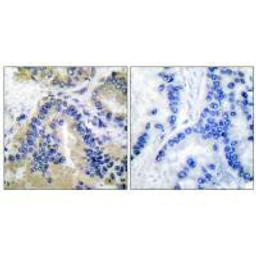 Immunohistochemical analysis of paraffin-embedded human lung carcinoma tissue using Caspase 10 antibody.