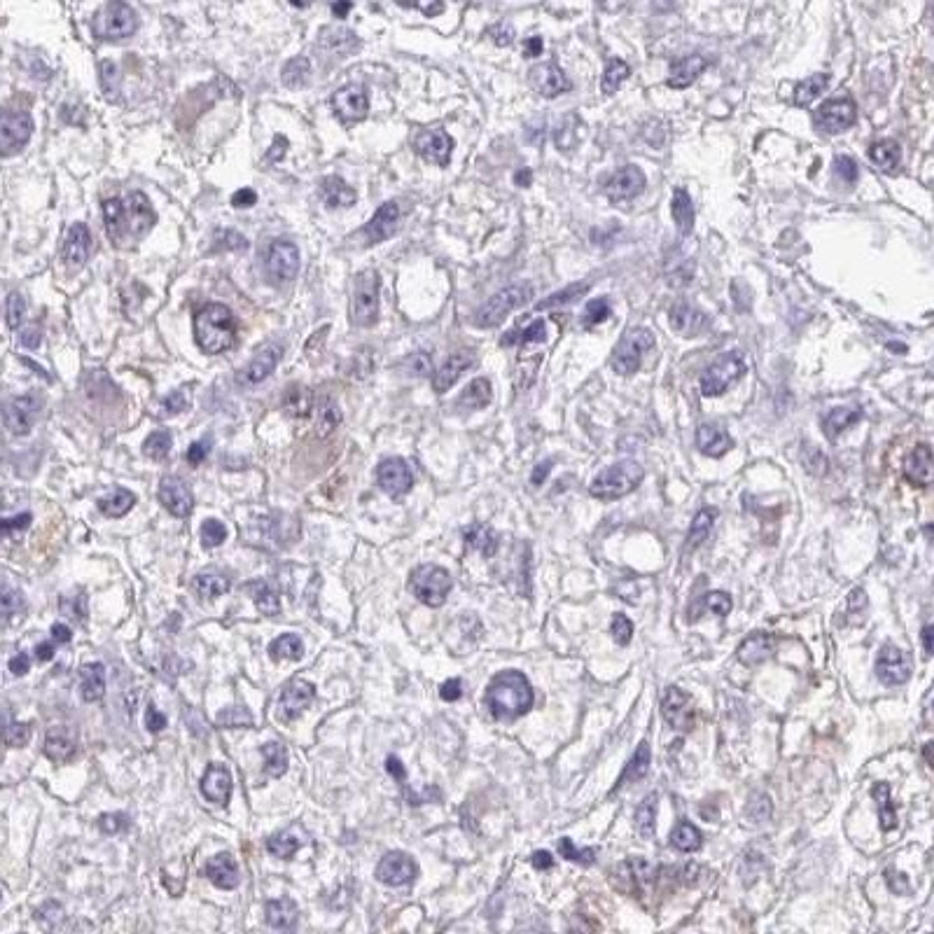 Immunohistochemistry: TMEM133 Antibody [NBP2-31829] - liver cancer