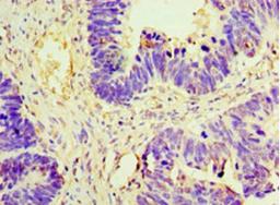 Immunohistochemistry of paraffin-embedded human ovarian cancer using CSB-PA12639A0Rb at dilution of 1:100