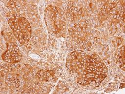 Immunohistochemistry-Paraffin: Calcium-binding-protein-P22 Antibody [NBP1-33736] - Paraffin-embedded SW480 xenograft, using antibody at 1:100 dilution.