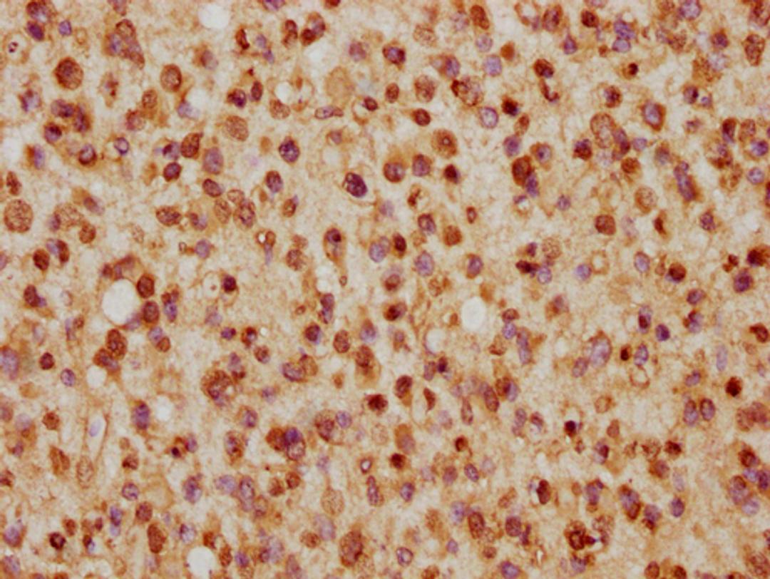 IHC image of CSB-PA010403PA57nhibHU diluted at 1:5 and staining in paraffin-embedded human glioma cancer performed on a Leica BondTM system. After dewaxing and hydration, antigen retrieval was mediated by high pressure in a citrate buffer (pH 6.0). Section was blocked with 10% normal goat serum 30min at RT. Then primary antibody (1% BSA) was incubated at 4°C overnight. The primary is detected by a biotinylated secondary antibody and visualized using an HRP conjugated SP system.