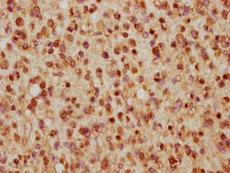 IHC image of CSB-PA010403PA57nhibHU diluted at 1:5 and staining in paraffin-embedded human glioma cancer performed on a Leica BondTM system. After dewaxing and hydration, antigen retrieval was mediated by high pressure in a citrate buffer (pH 6.0). Section was blocked with 10% normal goat serum 30min at RT. Then primary antibody (1% BSA) was incubated at 4°C overnight. The primary is detected by a biotinylated secondary antibody and visualized using an HRP conjugated SP system.