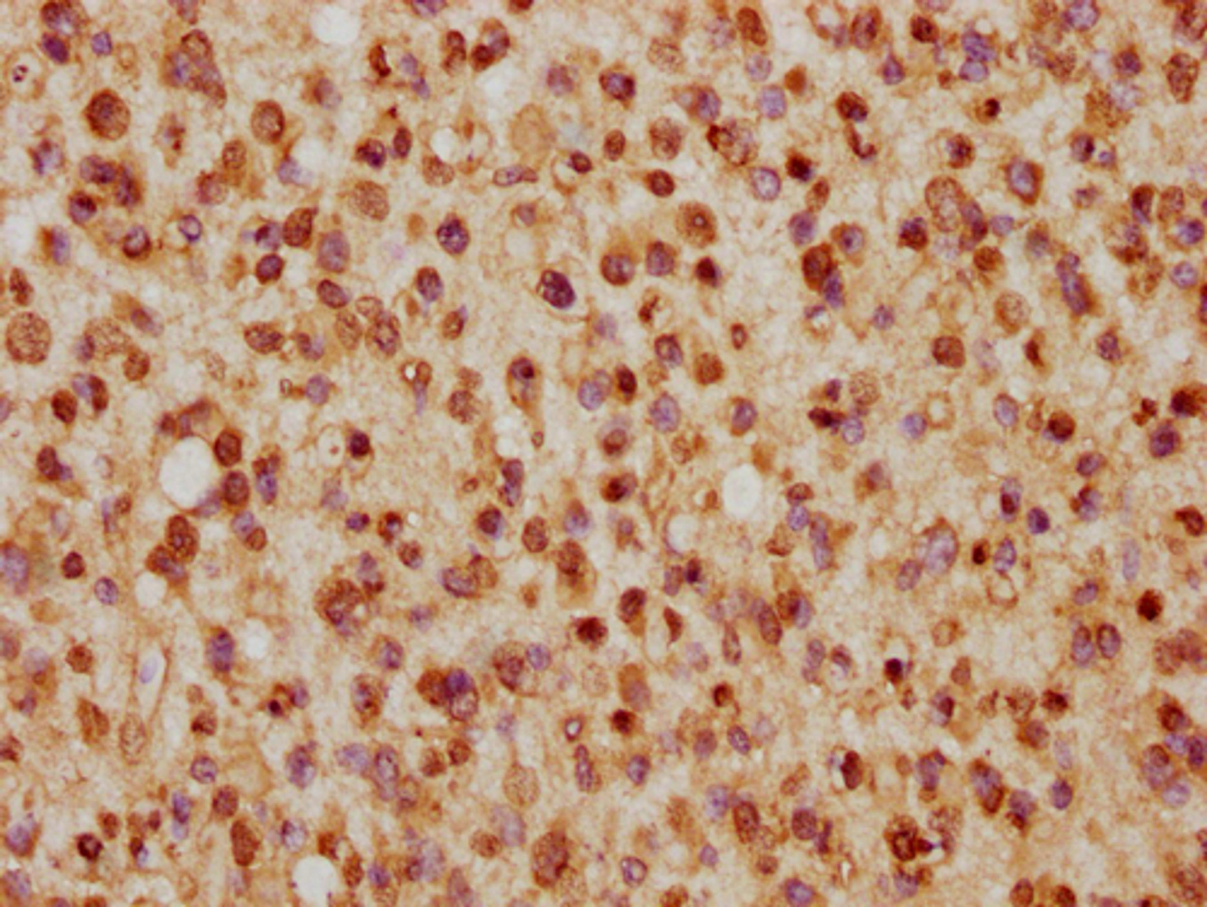 IHC image of CSB-PA010403PA57nhibHU diluted at 1:5 and staining in paraffin-embedded human glioma cancer performed on a Leica BondTM system. After dewaxing and hydration, antigen retrieval was mediated by high pressure in a citrate buffer (pH 6.0). Section was blocked with 10% normal goat serum 30min at RT. Then primary antibody (1% BSA) was incubated at 4°C overnight. The primary is detected by a biotinylated secondary antibody and visualized using an HRP conjugated SP system.