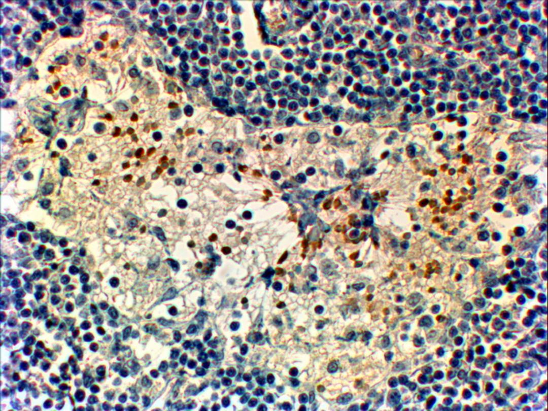 45-605 (2ug/ml) staining of paraffin embedded Human Breast cancer. Steamed antigen retrieval with Tris/EDTA buffer pH 9, HRP-staining.