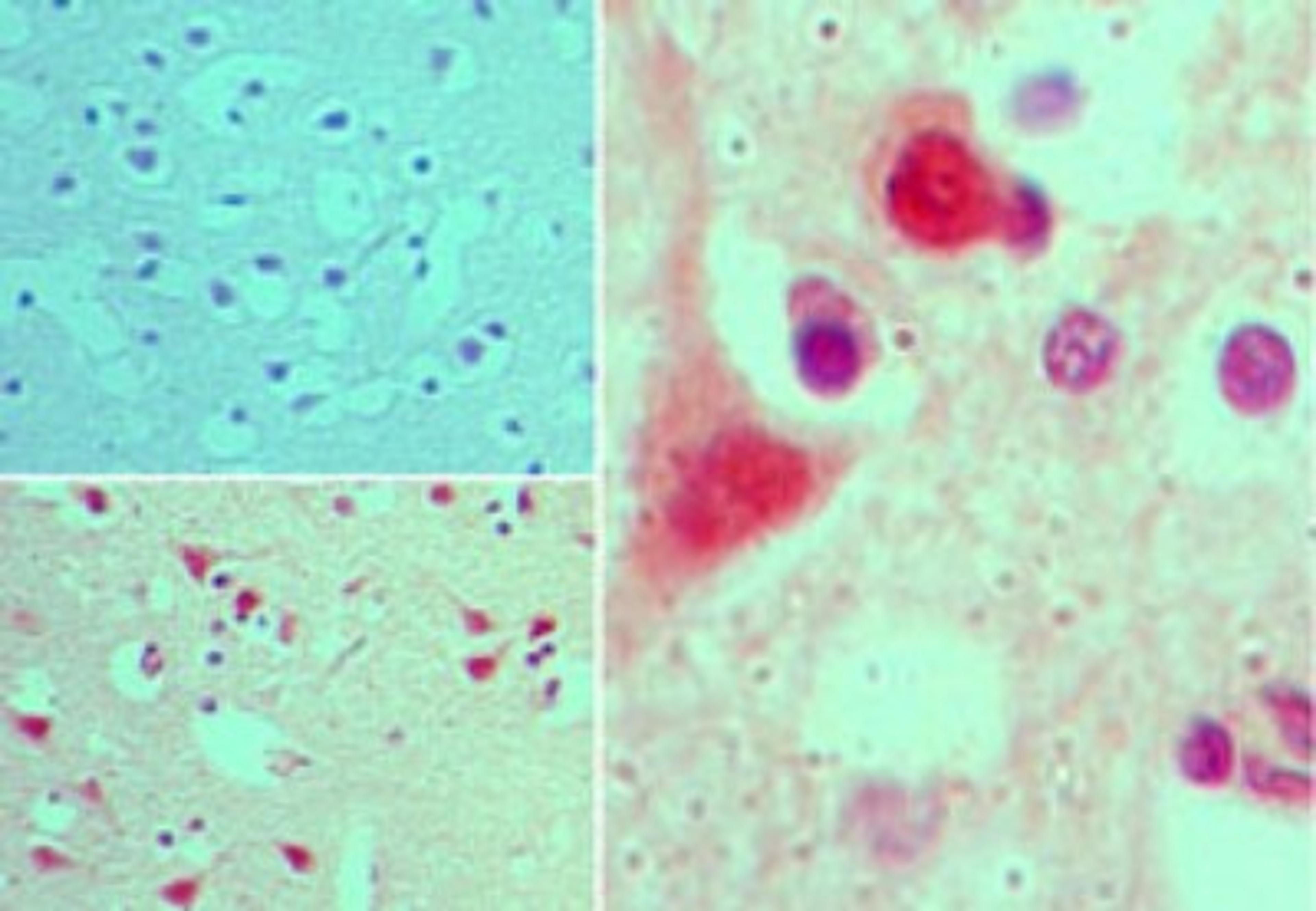 Immunohistochemistry-Paraffin: AGAP2 Antibody [NBP2-24498] - analysis of AGAP2 in formalin-fixed, paraffin-embedded human brain tissue using an isotype control (top left) and this antibody (bottom left, right) at 5 ug/ml.