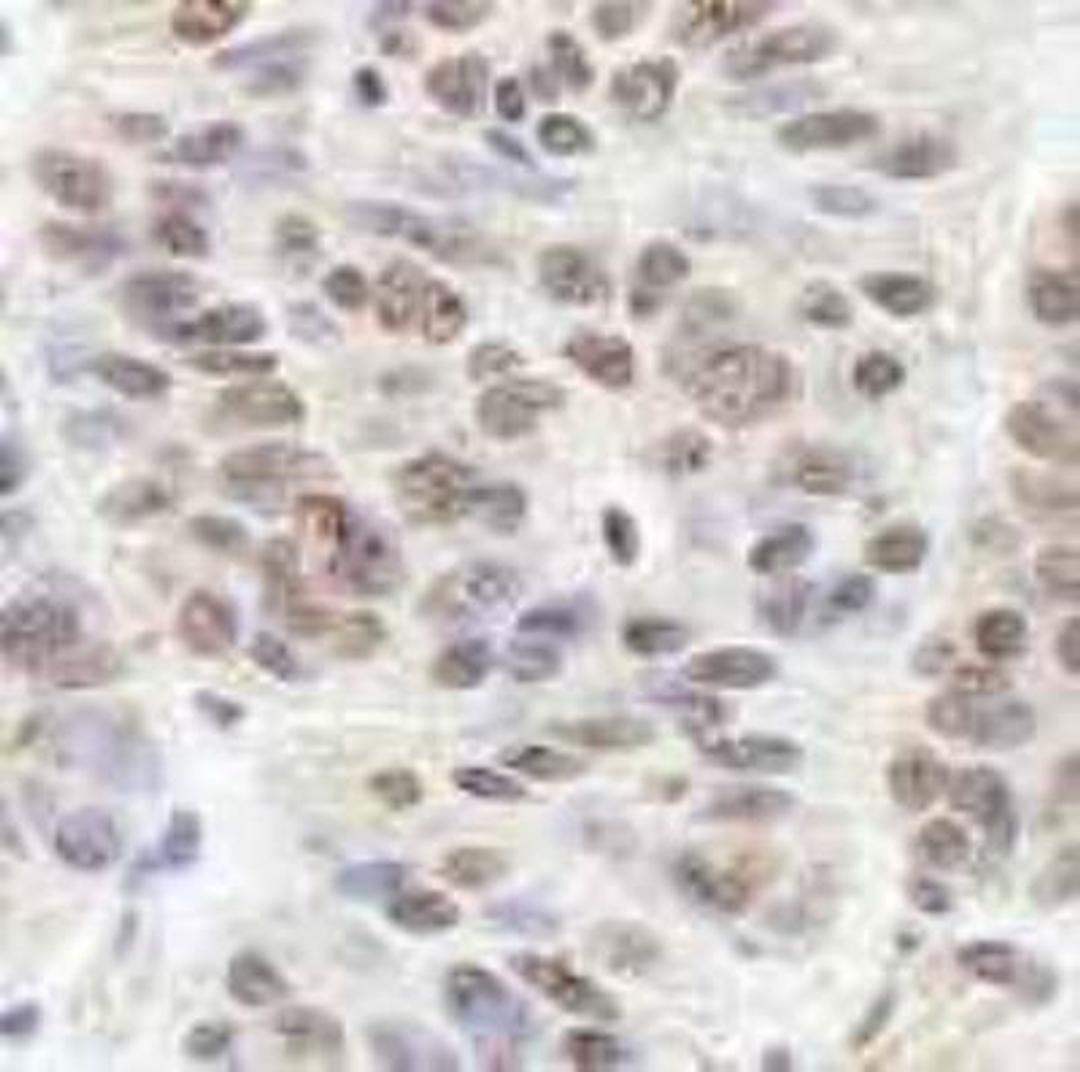 Immunohistochemistry-Paraffin: BLAP75 Antibody [NB100-1720] - FFPE section of human skin basal cell carcinoma. NB100-1720 used at a dilution of 1:250. DAB staining using anti-Rabbit IHC antibody at a dilution of 1:100.