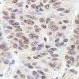 Immunohistochemistry-Paraffin: BLAP75 Antibody [NB100-1720] - FFPE section of human skin basal cell carcinoma. NB100-1720 used at a dilution of 1:250. DAB staining using anti-Rabbit IHC antibody at a dilution of 1:100.