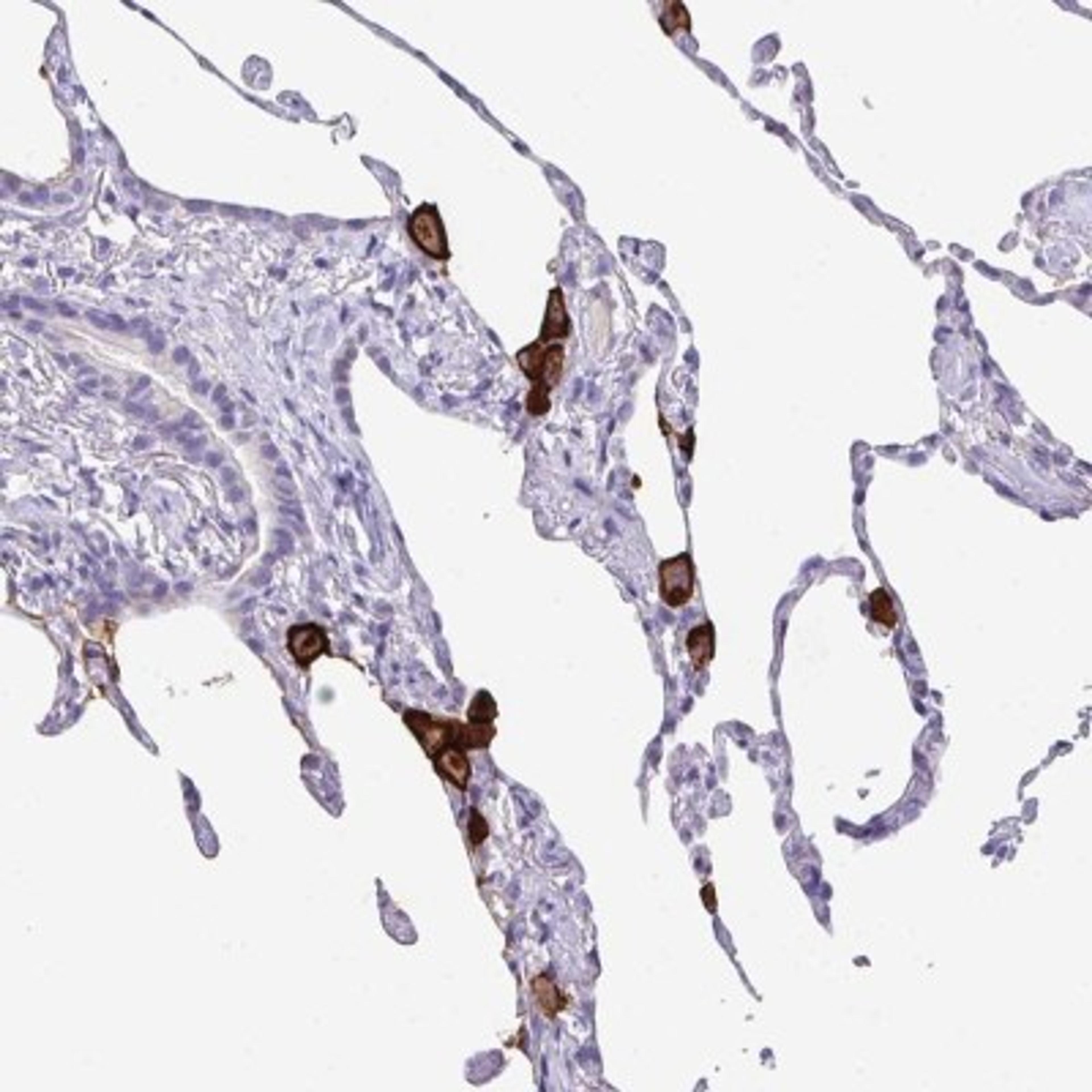 Immunohistochemistry: MARCO Antibody [NBP2-39004] - Staining of human lung shows strong positivity in macrophages.