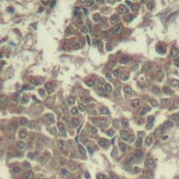 Immunohistochemical analysis of formalin-fixed and paraffin-embedded human breast carcinoma tissue using Jak2(Ab-570) antibody