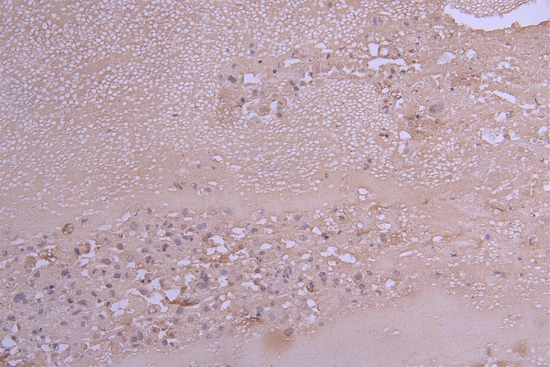 IHC image of CSB-RA004783MA1HU diluted at 1:100 and staining in paraffin-embedded human melanoma cancer performed on a Leica BondTM system. After dewaxing and hydration, antigen retrieval was mediated by high pressure in a citrate buffer (pH 6.0). Section was blocked with 10% normal goat serum 30min at RT. Then primary antibody (1% BSA) was incubated at 4°C overnight. The primary is detected by a Goat anti-Human IgG labeled by HRP and visualized using 0.05% DAB.