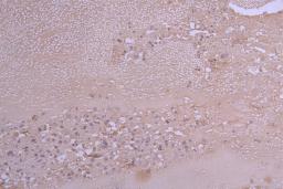 IHC image of CSB-RA004783MA1HU diluted at 1:100 and staining in paraffin-embedded human melanoma cancer performed on a Leica BondTM system. After dewaxing and hydration, antigen retrieval was mediated by high pressure in a citrate buffer (pH 6.0). Section was blocked with 10% normal goat serum 30min at RT. Then primary antibody (1% BSA) was incubated at 4°C overnight. The primary is detected by a Goat anti-Human IgG labeled by HRP and visualized using 0.05% DAB.