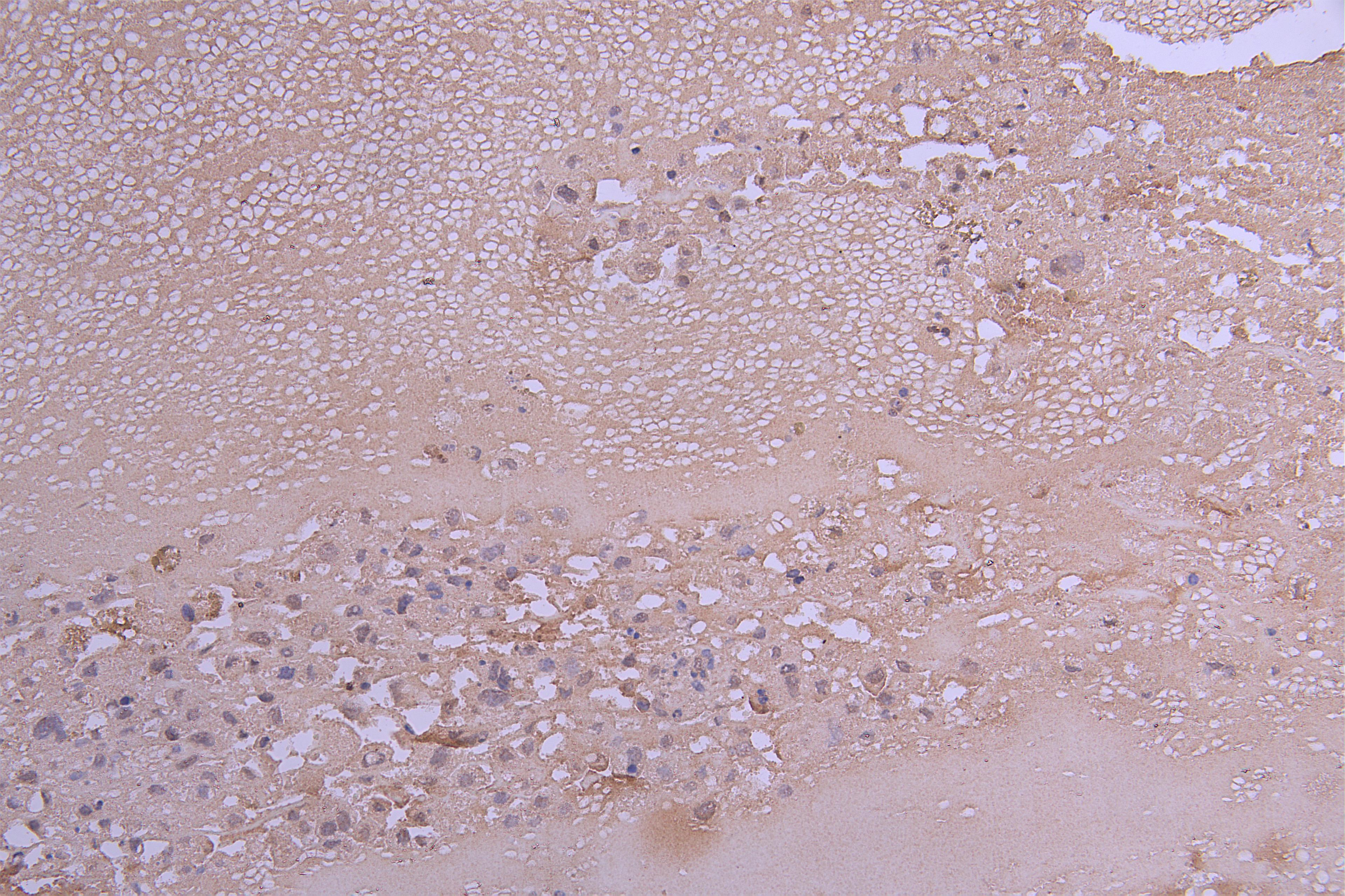IHC image of CSB-RA004783MA1HU diluted at 1:100 and staining in paraffin-embedded human melanoma cancer performed on a Leica BondTM system. After dewaxing and hydration, antigen retrieval was mediated by high pressure in a citrate buffer (pH 6.0). Section was blocked with 10% normal goat serum 30min at RT. Then primary antibody (1% BSA) was incubated at 4°C overnight. The primary is detected by a Goat anti-Human IgG labeled by HRP and visualized using 0.05% DAB.