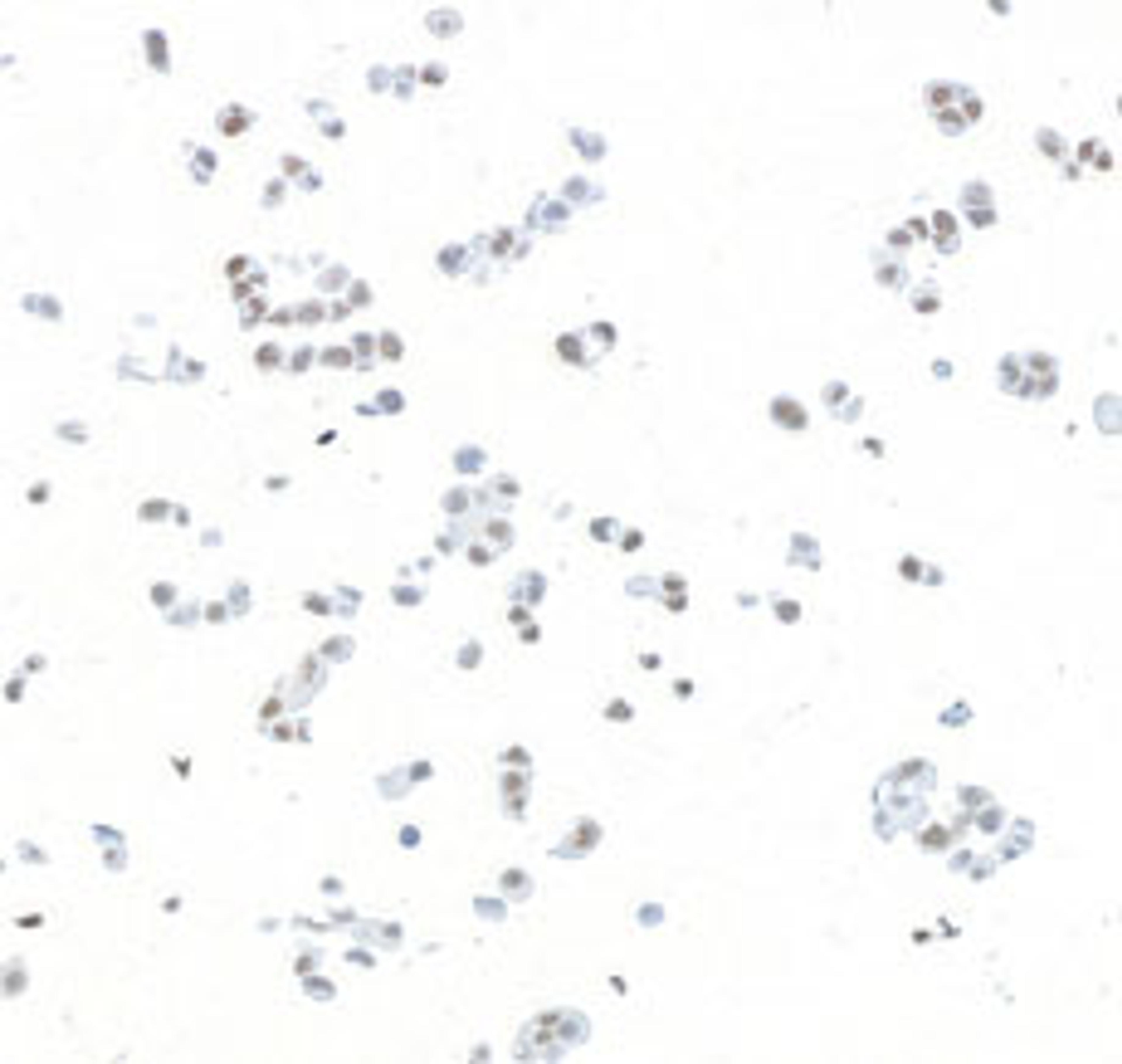 Detection of human PBRM1 in FFPE MCF7 cells by immunocytochemistry.