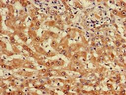 Immunohistochemistry of paraffin-embedded human liver cancer using CSB-PA622657LA01HU at dilution of 1:100