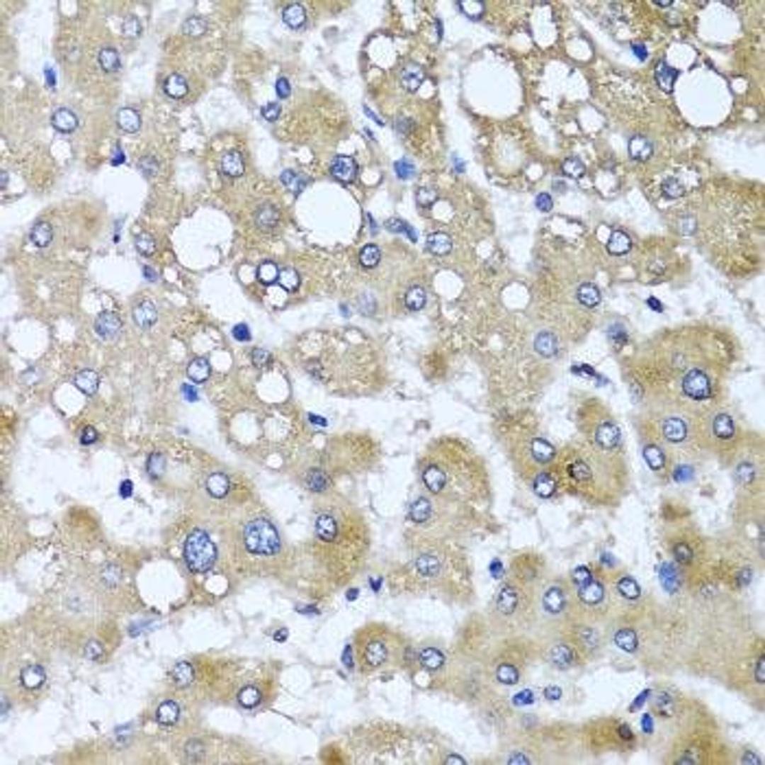 Immunohistochemical staining of human liver injury tissue using TTLL12 antibody (dilution of 1:100)