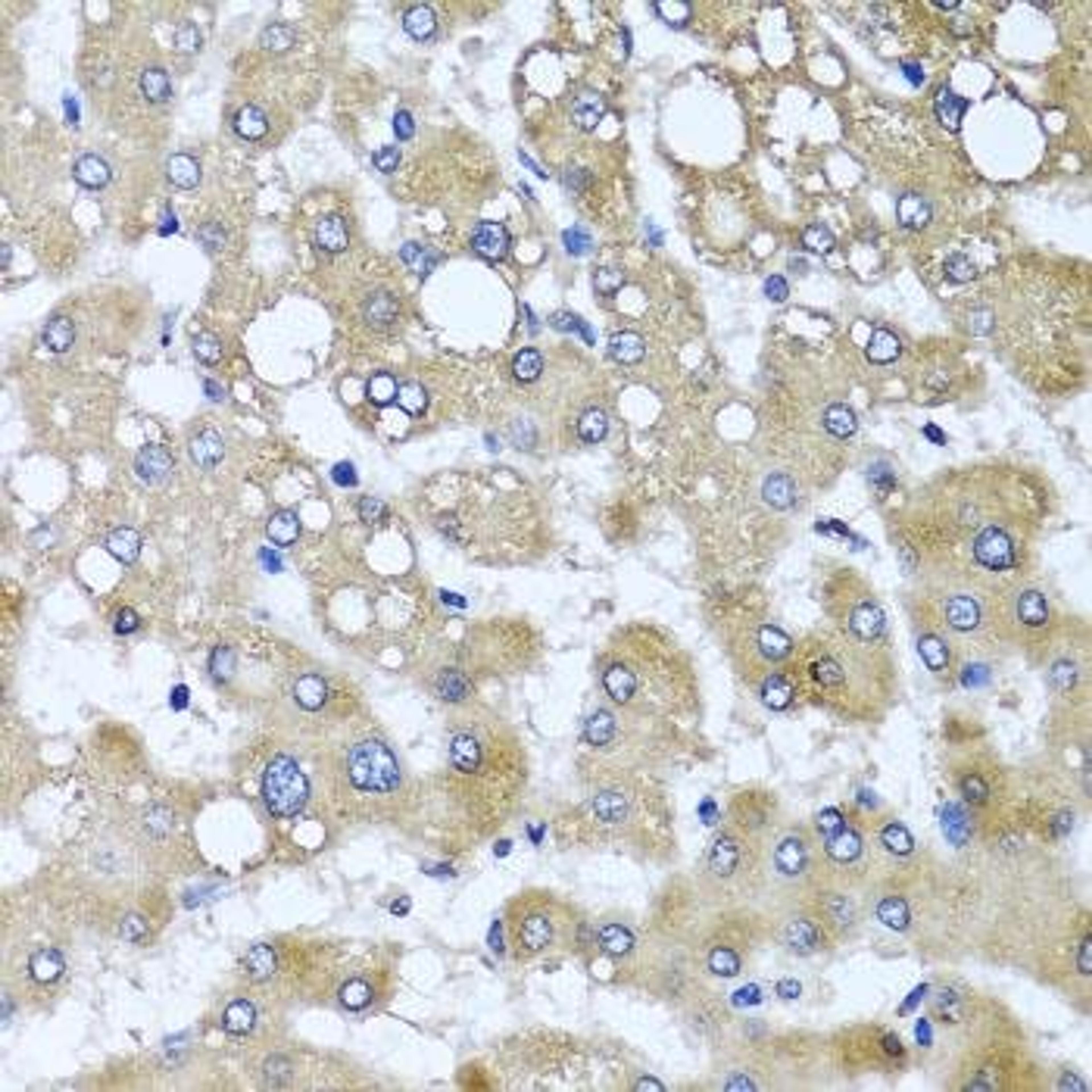 Immunohistochemical staining of human liver injury tissue using TTLL12 antibody (dilution of 1:100)