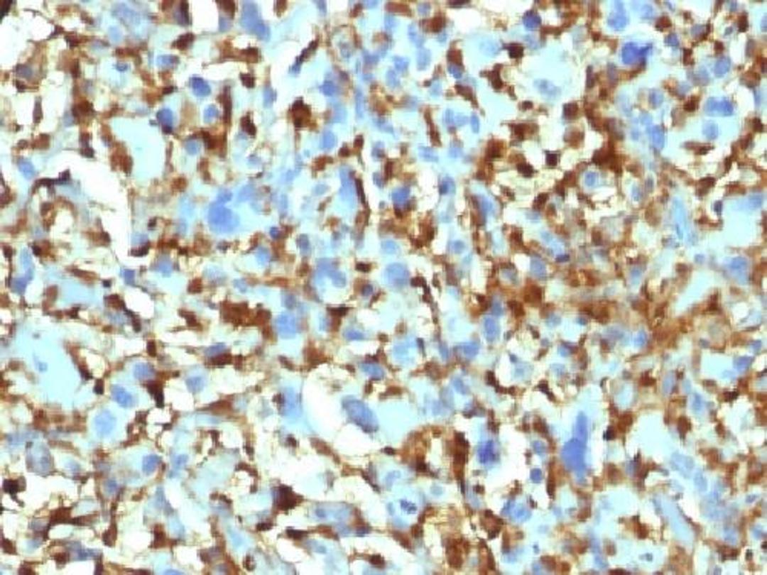 Immunohistochemical staining of human Histiocytoma tissue using F13A1 antibody