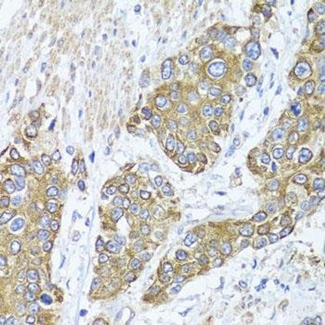 Immunohistochemical staining of human prostate cancer tissue using PEX14 antibody (dilution of 1:100)