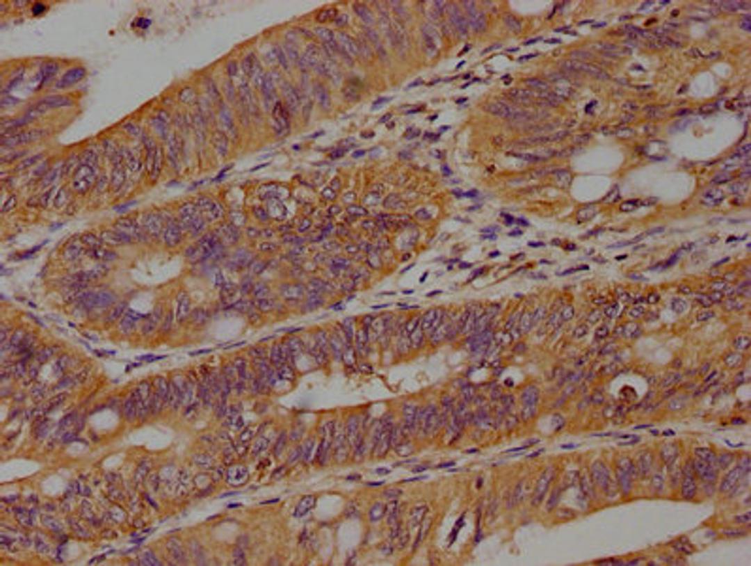 IHC image of CSB-PA897472OA01HU diluted at 1:100 and staining in paraffin-embedded human colon cancer performed on a Leica BondTM system. After dewaxing and hydration, antigen retrieval was mediated by high pressure in a citrate buffer (pH 6.0). Section was blocked with 10% normal goat serum 30min at RT. Then primary antibody (1% BSA) was incubated at 4°C overnight. The primary is detected by a biotinylated secondary antibody and visualized using an HRP conjugated SP system.