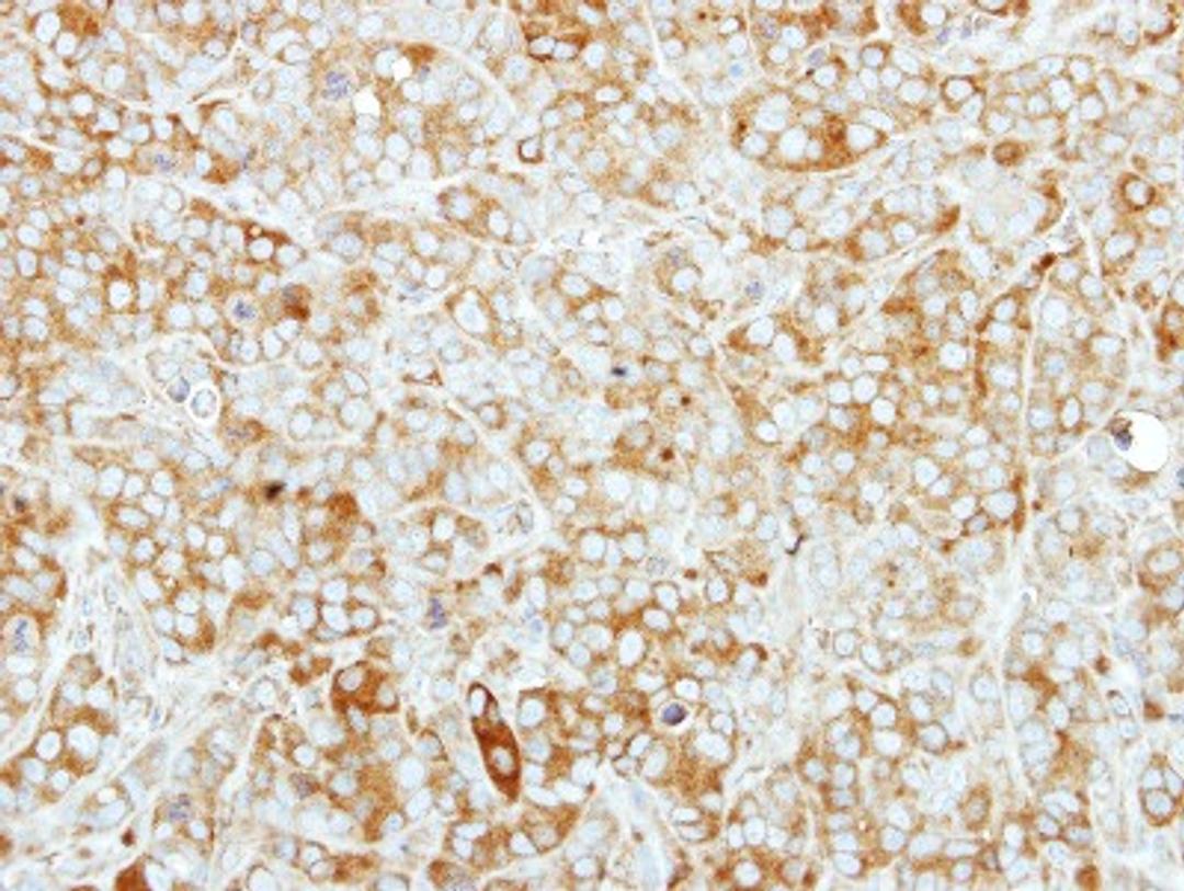 Immunohistochemistry-Paraffin: TARS Antibody [NBP2-20567] - Immunohistochemical analysis of paraffin-embedded MCF7 xenograft, using antibody at 1:250 dilution.