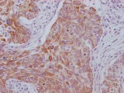 IHC image of CSB-MA949708 diluted at 1:100 and staining in paraffin-embedded human cervical cancer performed on a Leica BondTM system. After dewaxing and hydration, antigen retrieval was mediated by high pressure in a citrate buffer (pH 6.0). Section was blocked with 10% normal goat serum 30min at RT. Then primary antibody (1% BSA) was incubated at 4°C overnight. The primary is detected by a Goat anti-mouse IgG polymer labeled by HRP and visualized using 0.05% DAB.