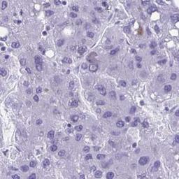 Immunohistochemistry-Paraffin: Thyrotropin Releasing Hormone Antibody [NBP2-34014] - liver cancer