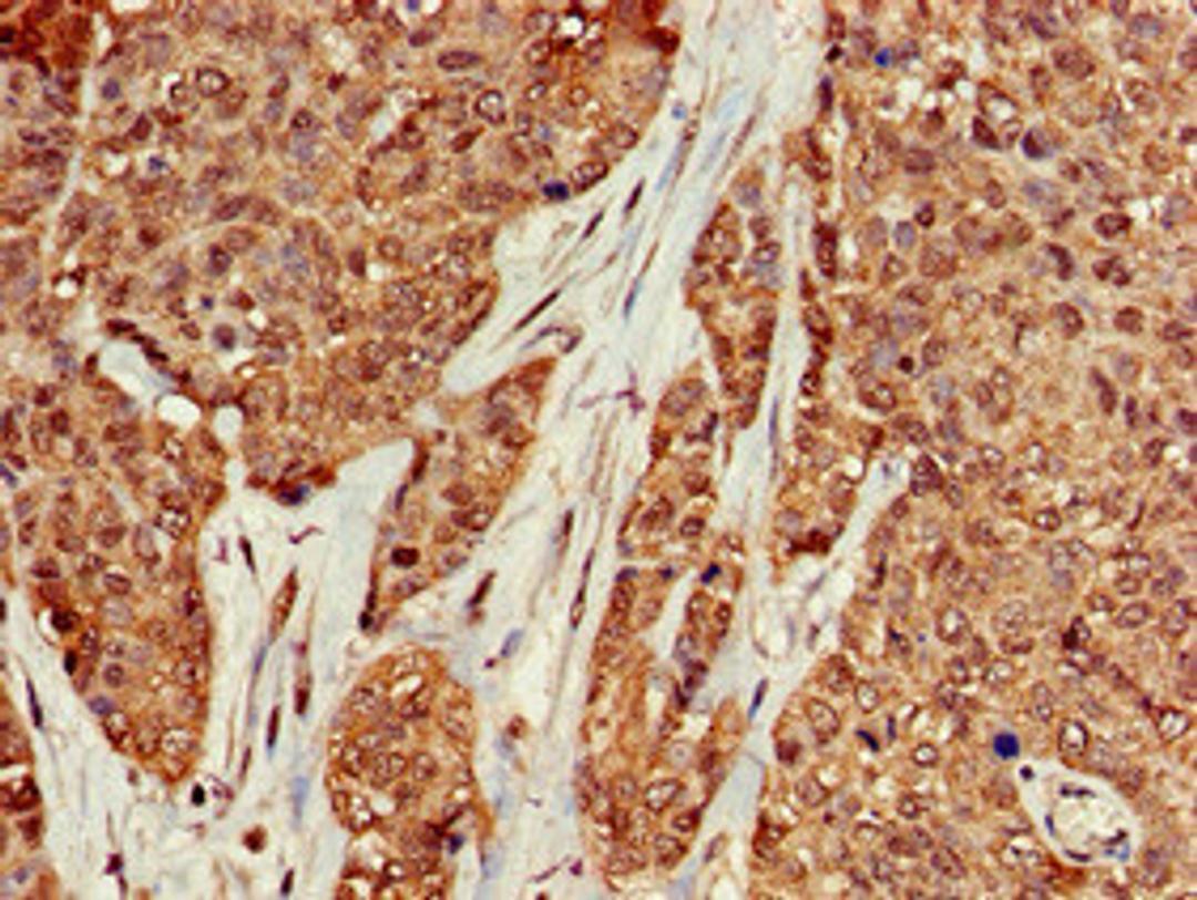 Immunohistochemistry of paraffin-embedded human ovarian cancer using CSB-PA13967A0Rb at dilution of 1:100