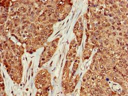 Immunohistochemistry of paraffin-embedded human ovarian cancer using CSB-PA13967A0Rb at dilution of 1:100