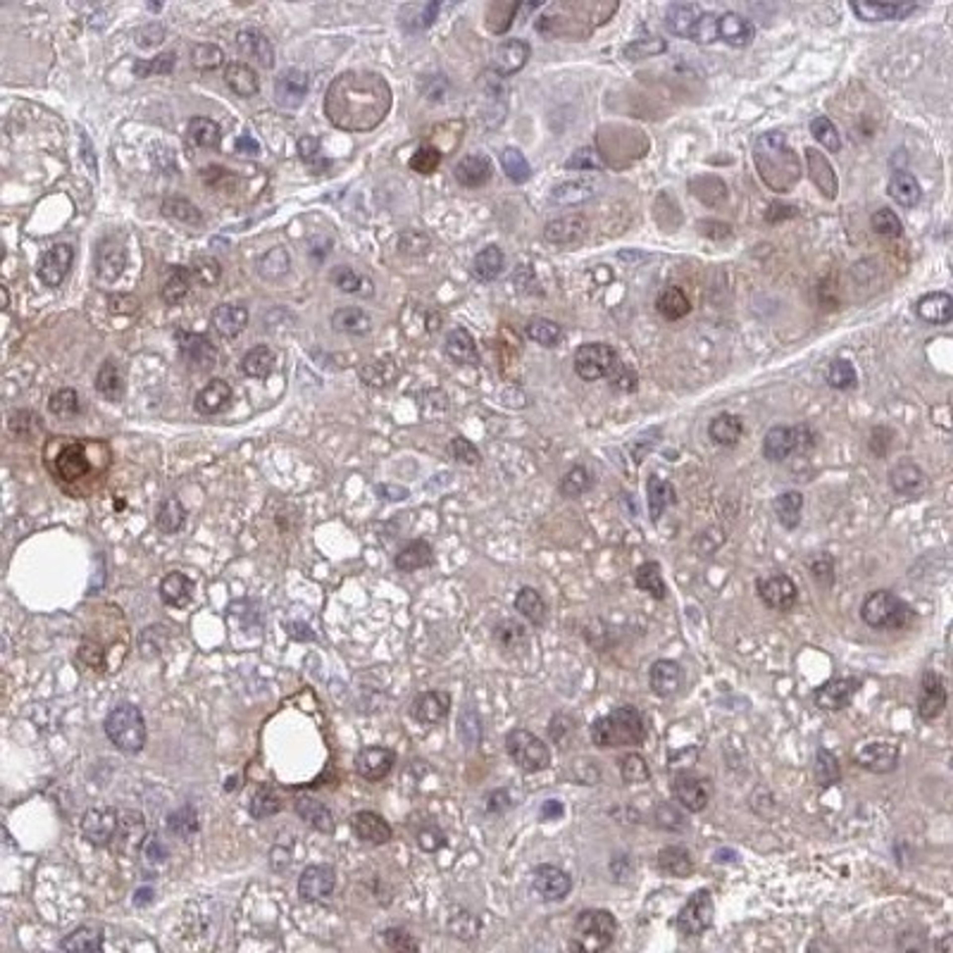 Immunohistochemistry: ZNF691 Antibody [NBP2-31858] - liver cancer