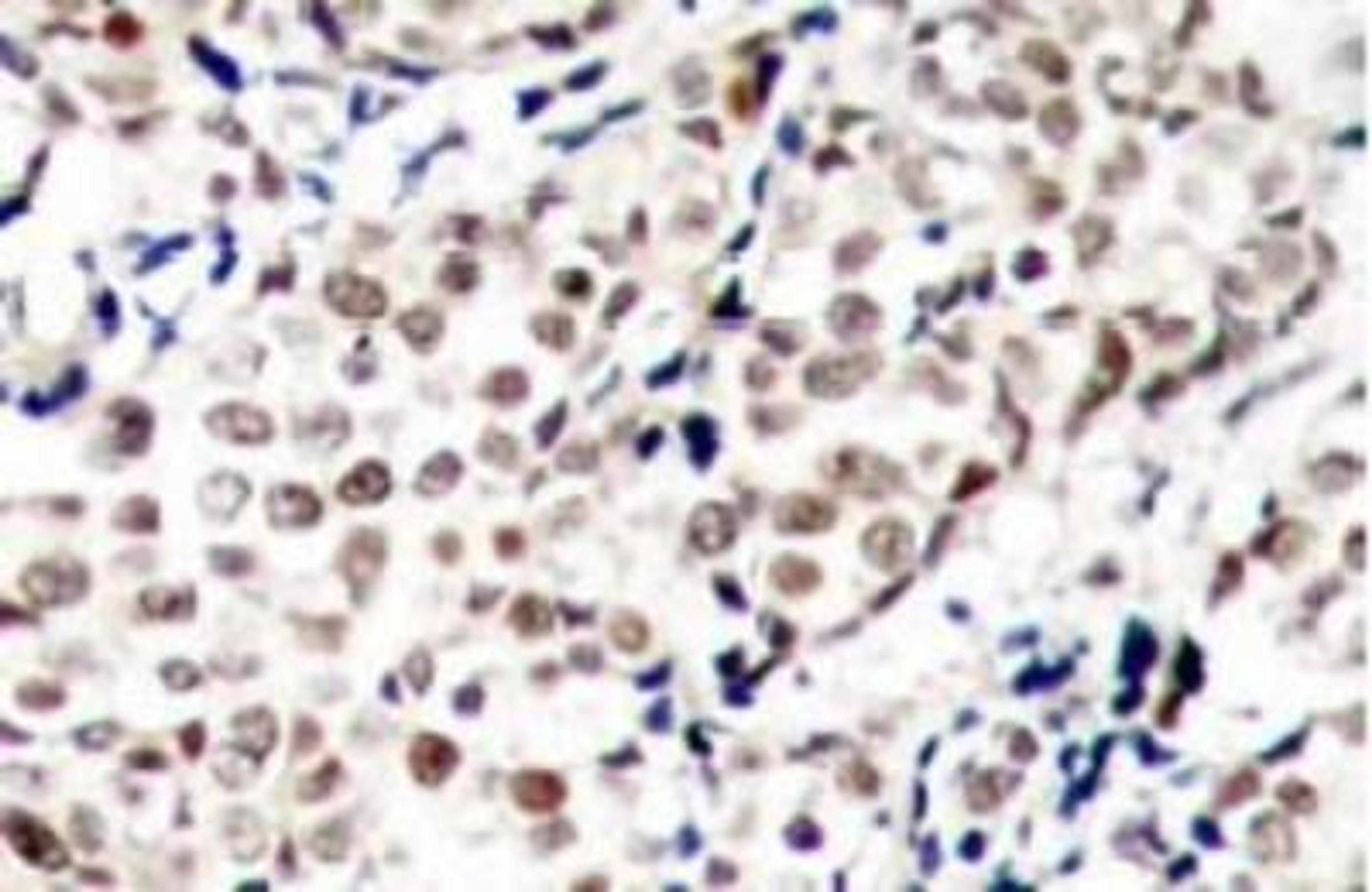 Immunohistochemistry: Chk1 [p Ser345] Antibody [NB100-92500] - Analysis of p-Chk1  (S345) antibody in paraffin-embedded human breast  carcinoma tissue.