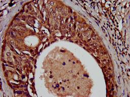 IHC image of CSB-PA883417LA01HU diluted at 1:500 and staining in paraffin-embedded human cervical cancer performed on a Leica BondTM system. After dewaxing and hydration, antigen retrieval was mediated by high pressure in a citrate buffer (pH 6.0). Section was blocked with 10% normal goat serum 30min at RT. Then primary antibody (1% BSA) was incubated at 4°C overnight. The primary is detected by a biotinylated secondary antibody and visualized using an HRP conjugated SP system.