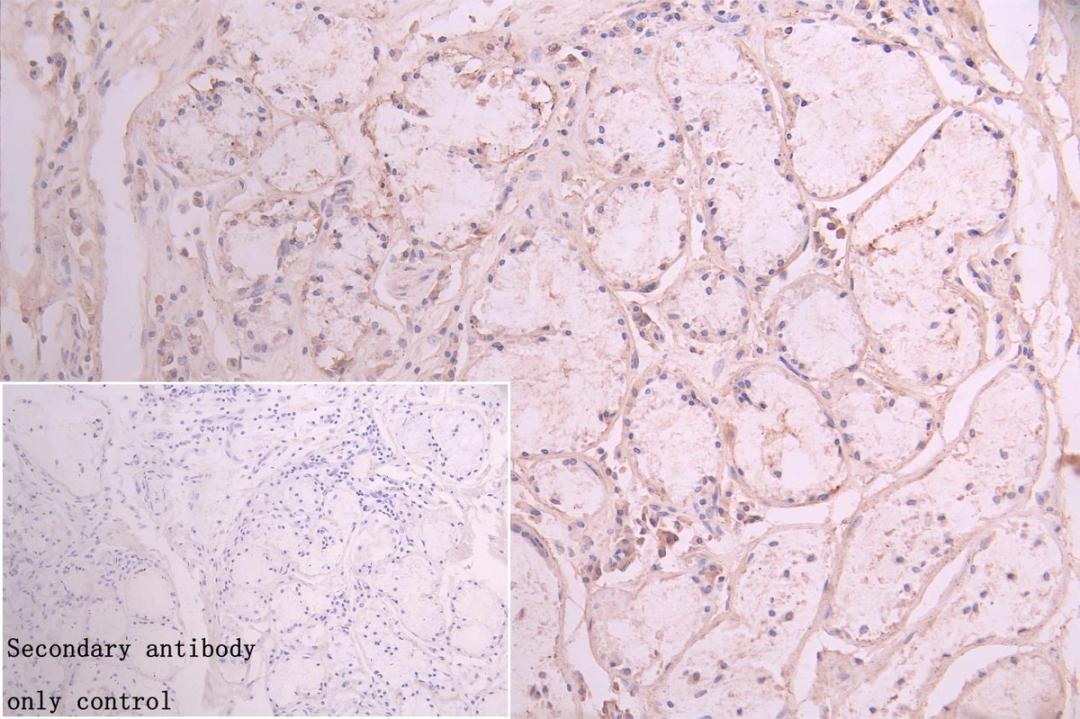 Immunohistochemistry of paraffin-embedded human lung cancer using CSB-PA857882LA01HU at dilution of 1:100