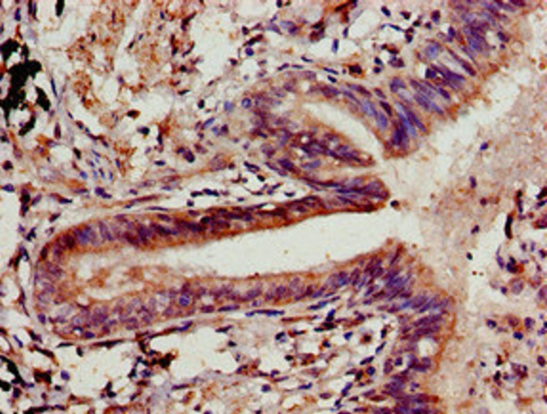 Immunohistochemistry of paraffin-embedded human lung cancer using CSB-PA005507LA01HU at dilution of 1:100