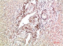 Immunohistochemical analysis of paraffin-embedded Human Liver Carcinoma Tissue using TTR Mouse mAb diluted at 1:200.