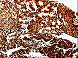 The image is immunohistochemistry of paraffin-embedded Human liver cancer tissue using CSB-PA797584(MMP13 Antibody) at dilution 1/10. (Original magnification: ×200)