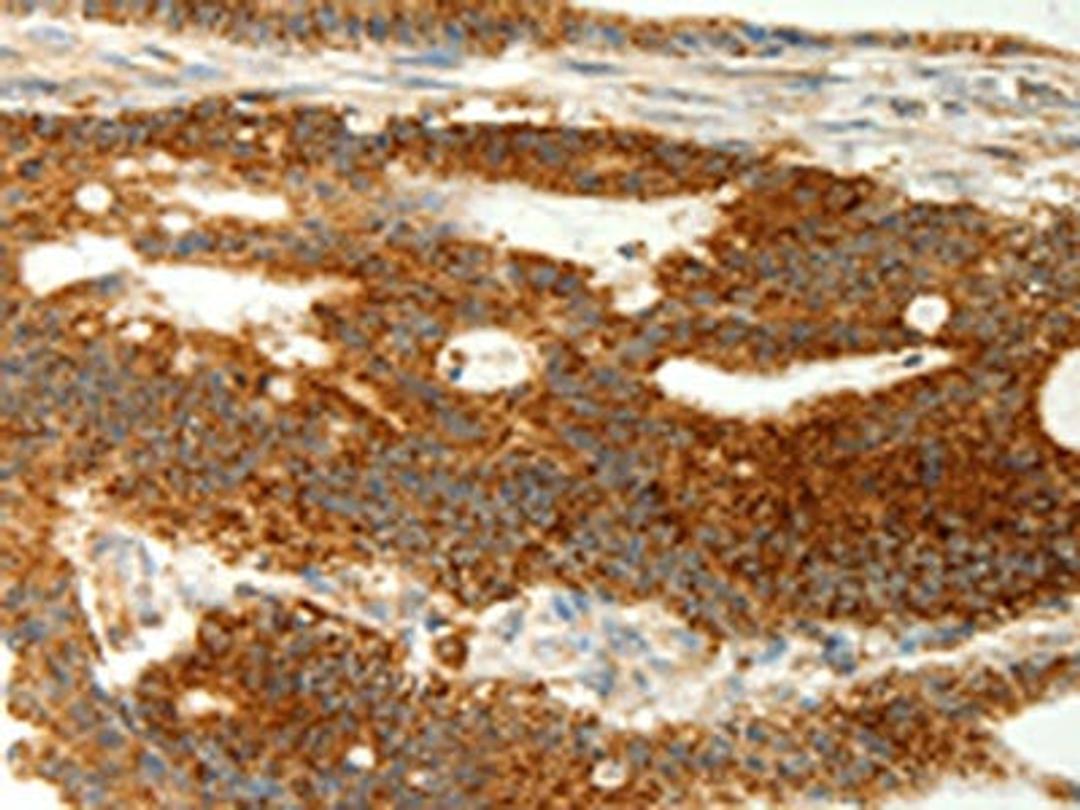 The image on the left is immunohistochemistry of paraffin-embedded Human colon cancer tissue using CSB-PA017662(COX7B Antibody) at dilution 1/70, on the right is treated with fusion protein. (Original magnification: ×200)