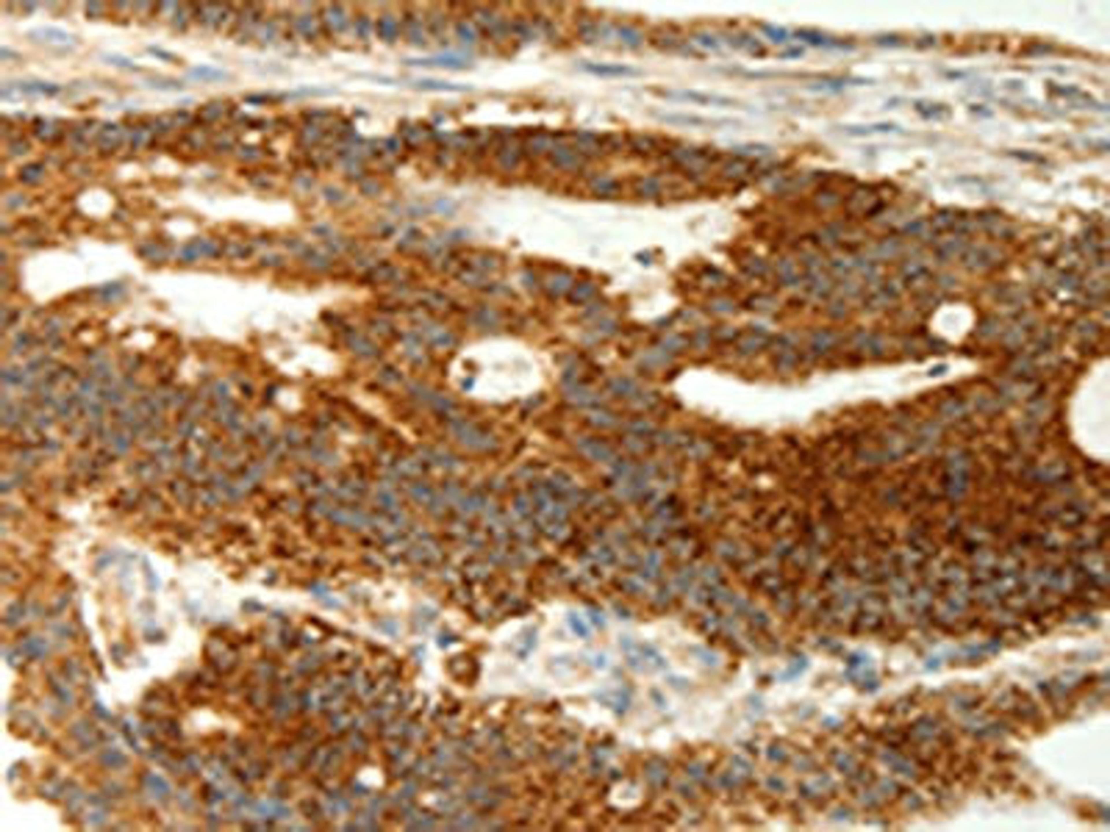 The image on the left is immunohistochemistry of paraffin-embedded Human colon cancer tissue using CSB-PA017662(COX7B Antibody) at dilution 1/70, on the right is treated with fusion protein. (Original magnification: ×200)