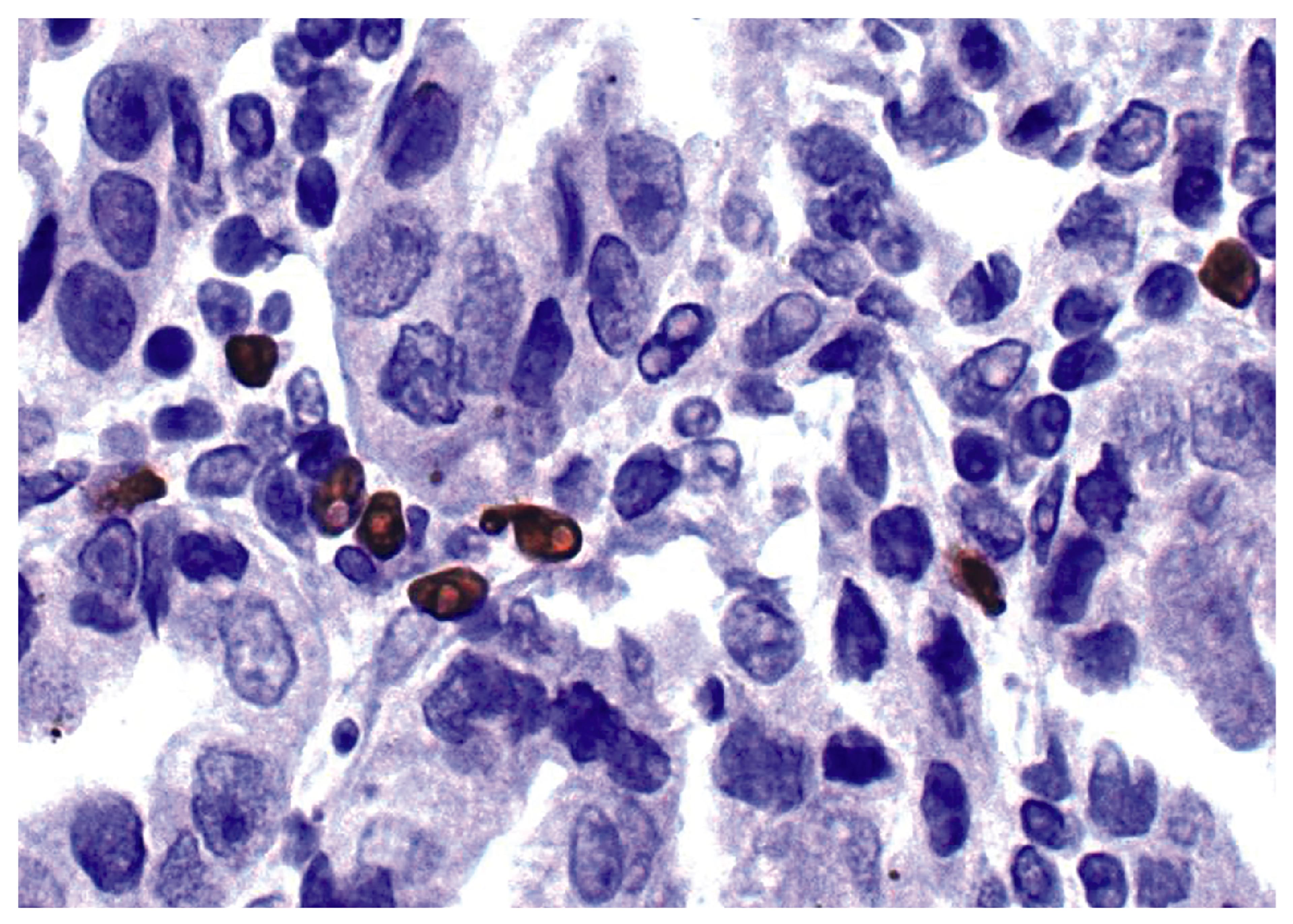 Human gastric cancer tissue was stained with Mouse Anti-Human Foxp3-UNLB (Cat. No. 99-788) followed by HRP conjugated Anti-Mouse Ig secondary antibody.