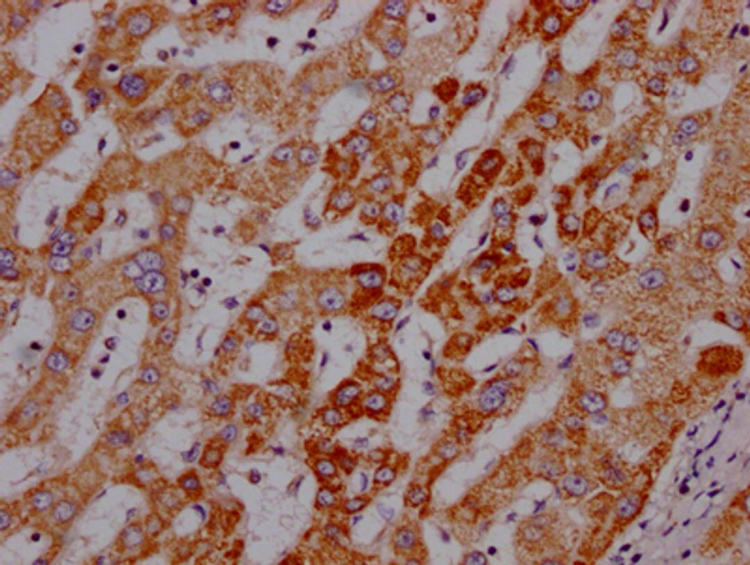 IHC image of CSB-RA191985A0HU diluted at 1:100 and staining in paraffin-embedded human liver cancer performed on a Leica BondTM system. After dewaxing and hydration, antigen retrieval was mediated by high pressure in a citrate buffer (pH 6.0). Section was blocked with 10% normal goat serum 30min at RT. Then primary antibody (1% BSA) was incubated at 4℃ overnight. The primary is detected by a Goat anti-rabbit IgG polymer labeled by HRP and visualized using 0.05% DAB.