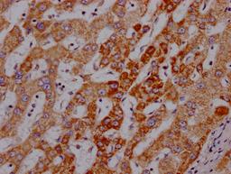 IHC image of CSB-RA191985A0HU diluted at 1:100 and staining in paraffin-embedded human liver cancer performed on a Leica BondTM system. After dewaxing and hydration, antigen retrieval was mediated by high pressure in a citrate buffer (pH 6.0). Section was blocked with 10% normal goat serum 30min at RT. Then primary antibody (1% BSA) was incubated at 4℃ overnight. The primary is detected by a Goat anti-rabbit IgG polymer labeled by HRP and visualized using 0.05% DAB.