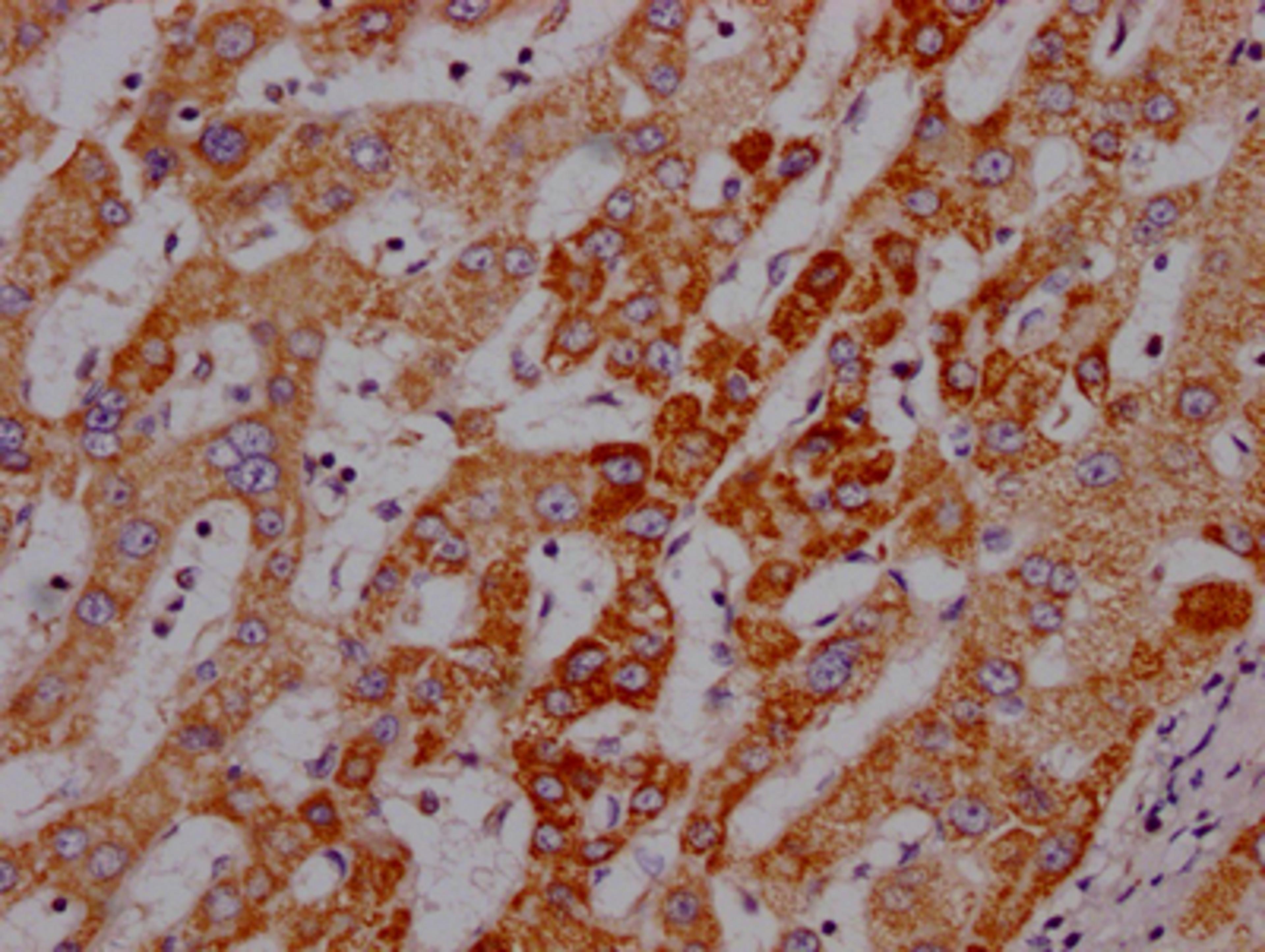 IHC image of CSB-RA191985A0HU diluted at 1:100 and staining in paraffin-embedded human liver cancer performed on a Leica BondTM system. After dewaxing and hydration, antigen retrieval was mediated by high pressure in a citrate buffer (pH 6.0). Section was blocked with 10% normal goat serum 30min at RT. Then primary antibody (1% BSA) was incubated at 4℃ overnight. The primary is detected by a Goat anti-rabbit IgG polymer labeled by HRP and visualized using 0.05% DAB.