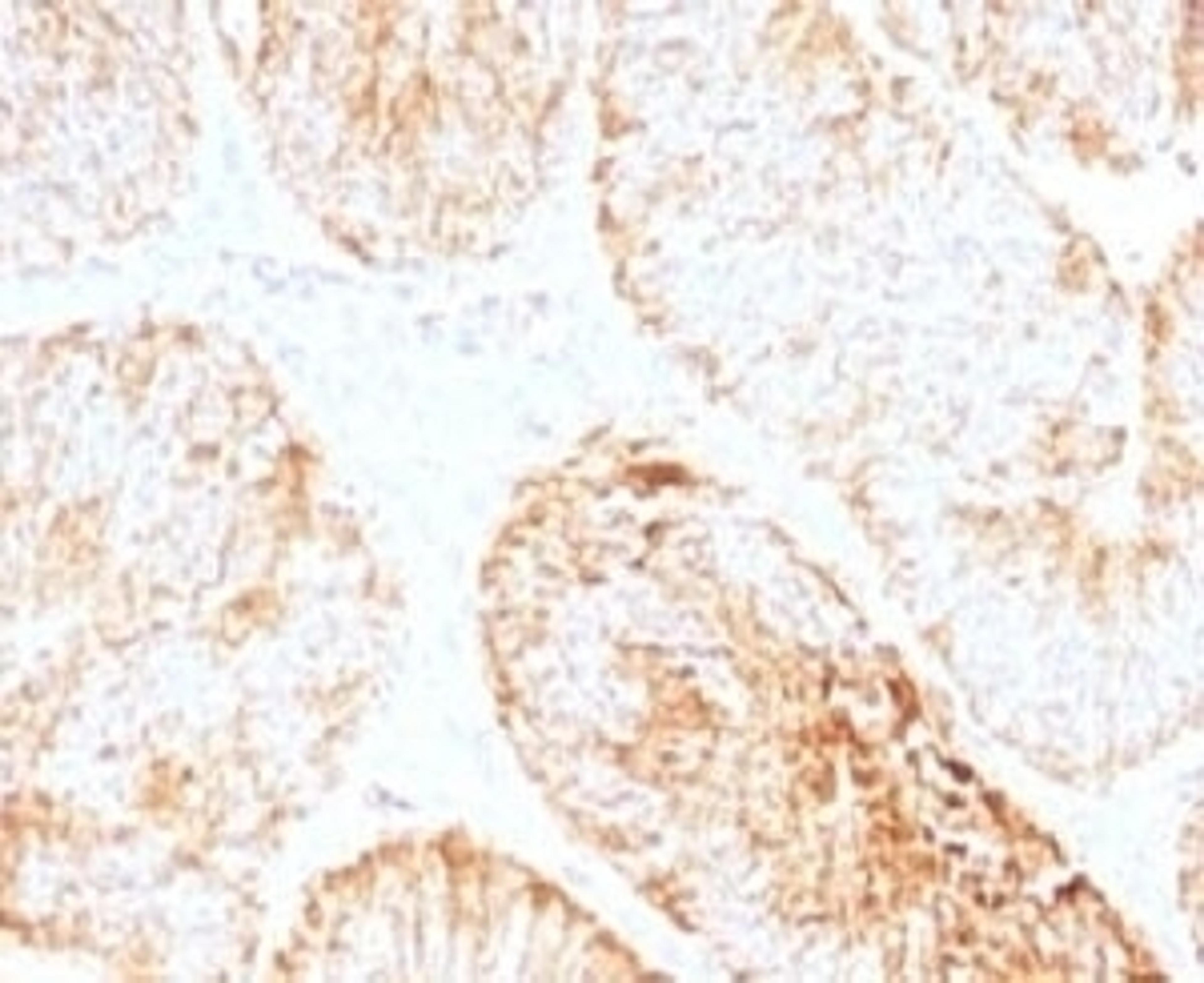 IHC testing of FFPE human colon carcinoma and IL-6 antibody.