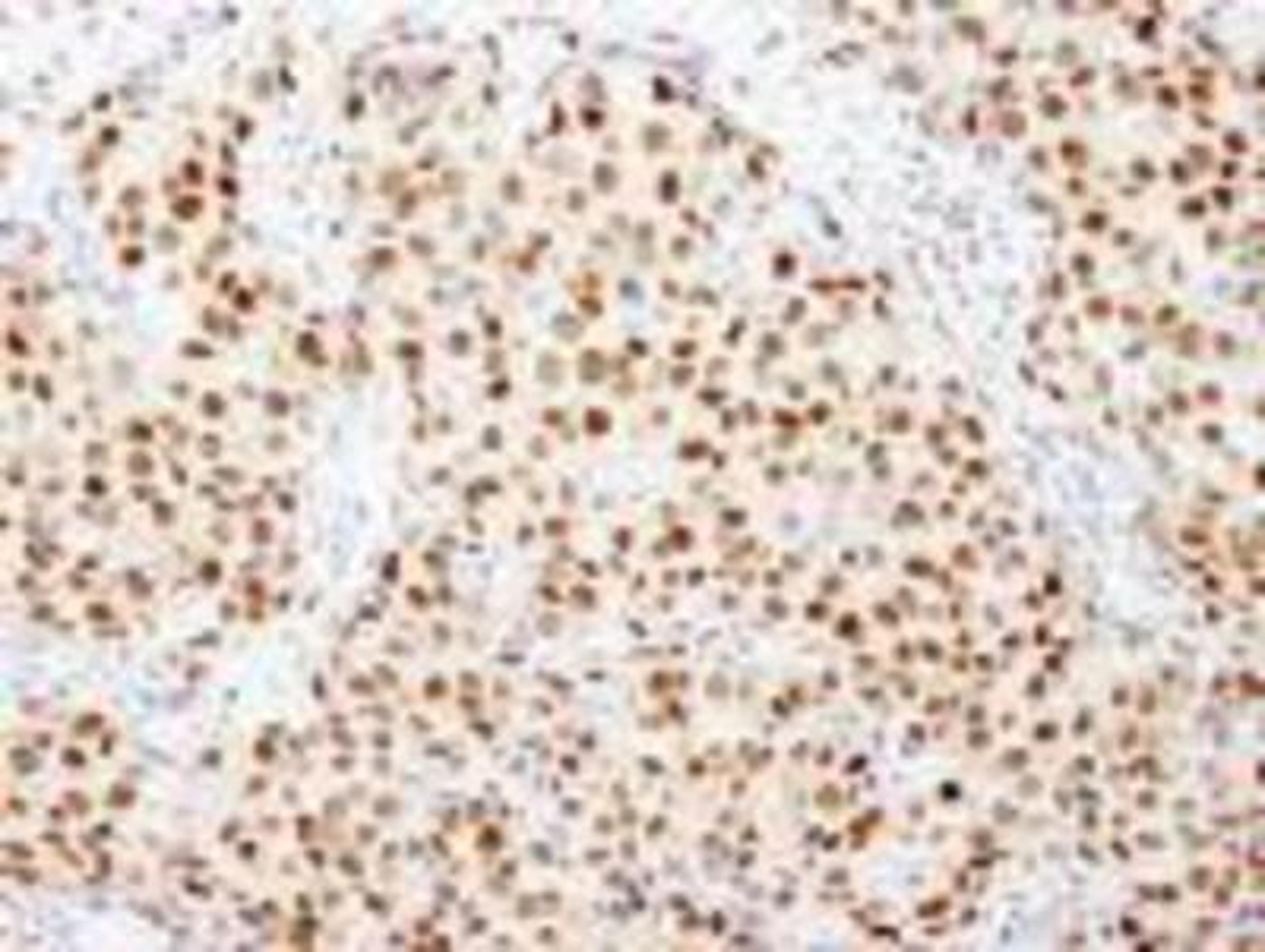 Immunohistochemistry-Paraffin: FKBP5/FKBP51 Antibody [NB100-68240] - FFPE section of human breast carcinoma. Affinity purified rabbit anti-FKBP5/FKBP51 used at a dilution of 1:500.