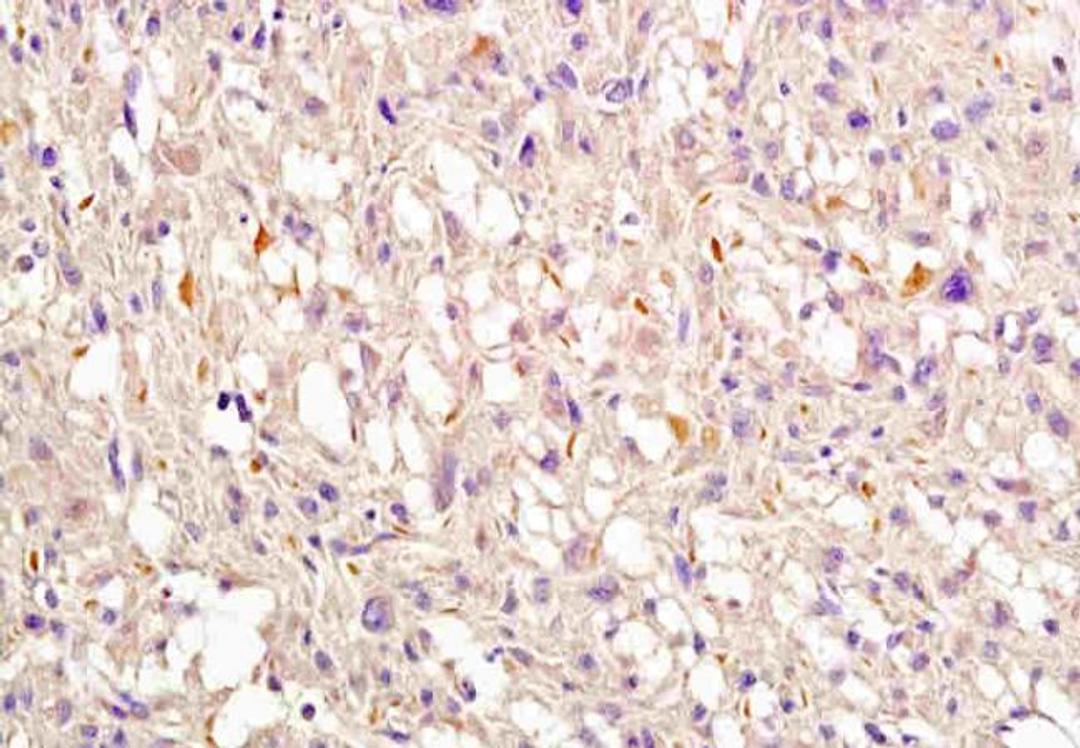 IHC-P of human endometrial cancer using Nrf2 (phospho-Ser40) antibody.