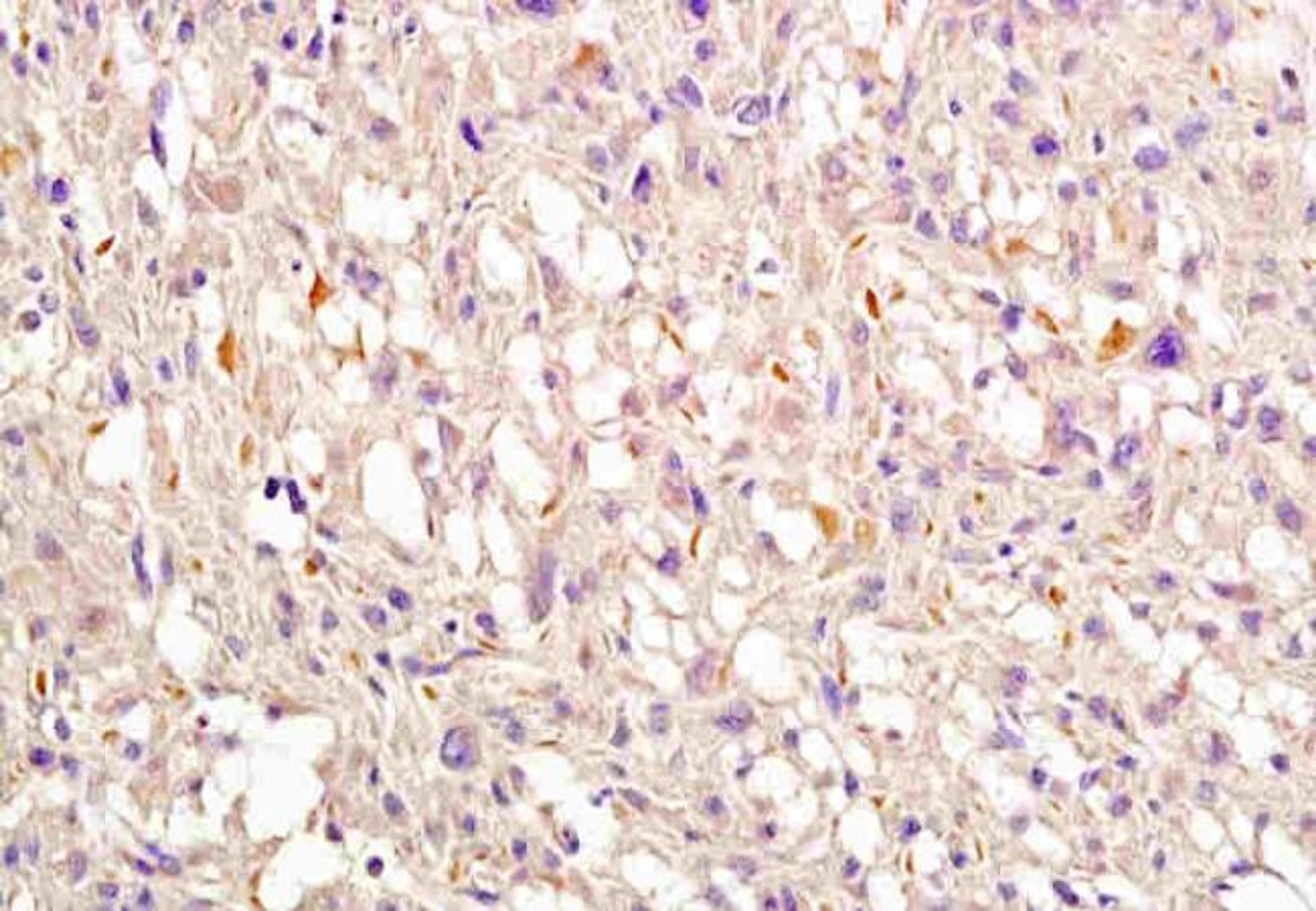 IHC-P of human endometrial cancer using Nrf2 (phospho-Ser40) antibody.