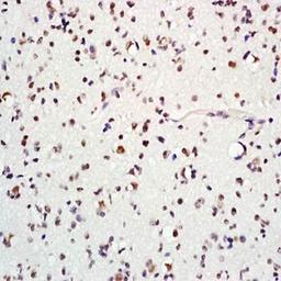 Immunohistochemical analysis of formalin-fixed and paraffin embedded human glioma tissue (dilution at:1:200) using MASH1/Achaete-scute homolog 1 antibody