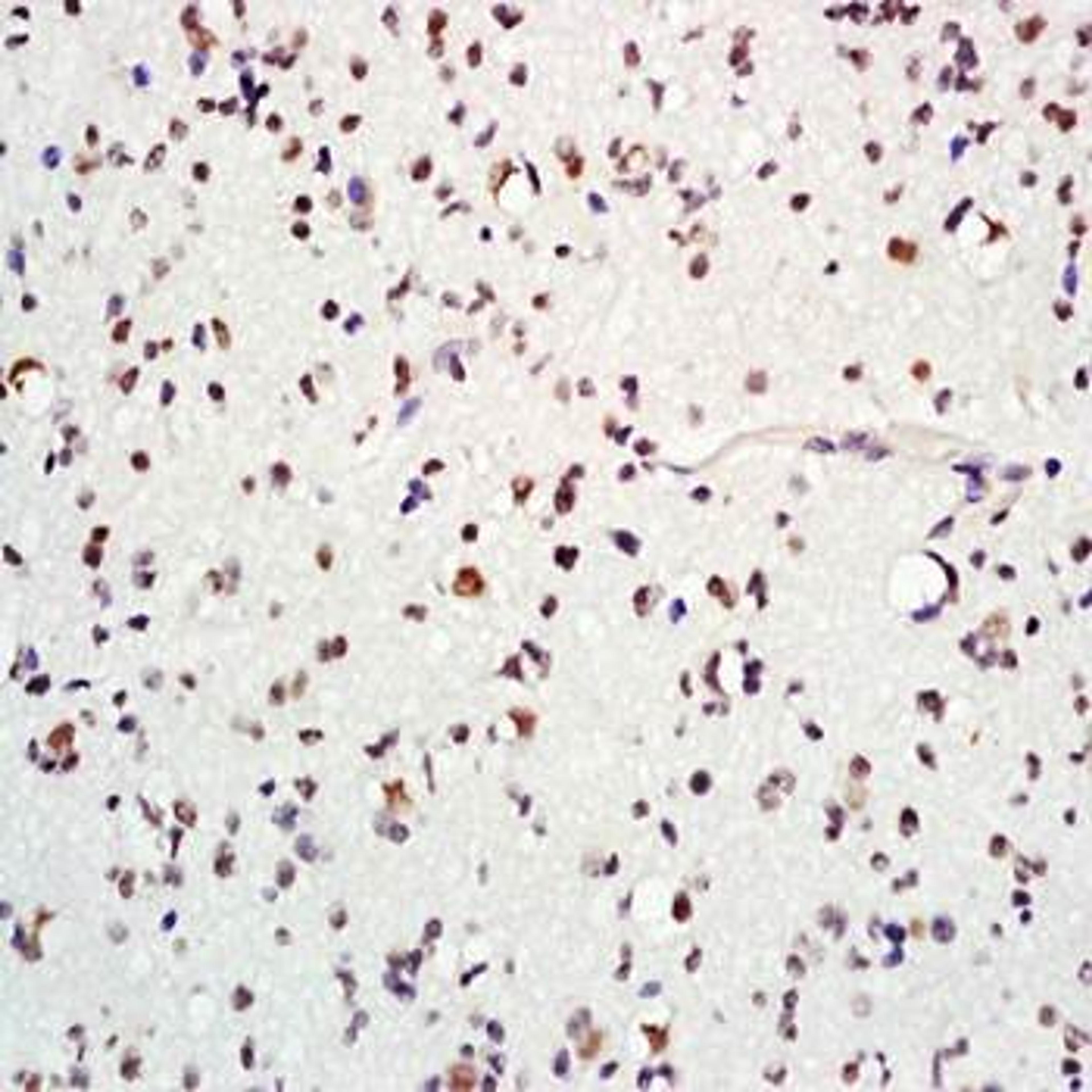 Immunohistochemical analysis of formalin-fixed and paraffin embedded human glioma tissue (dilution at:1:200) using MASH1/Achaete-scute homolog 1 antibody